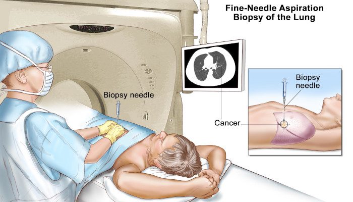 Life Expectancy After Breast Cancer Metastasis To Brain