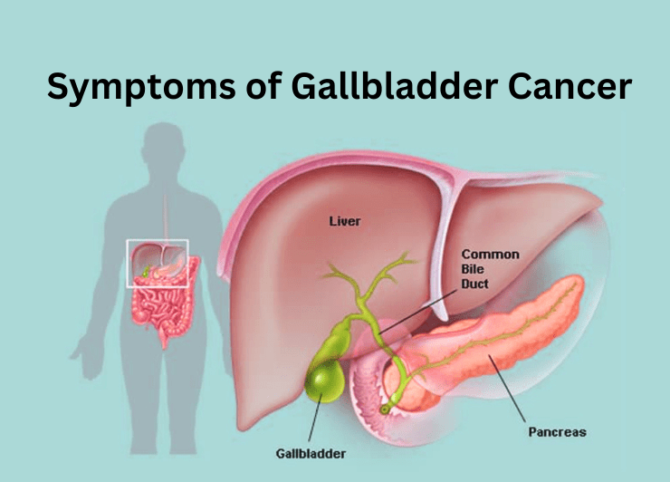 10 Advance Stage Symptoms Of Gallbladder Cancer