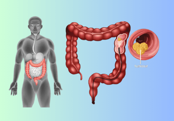 six-ways-to-lower-your-risk-for-colorectal-cancer